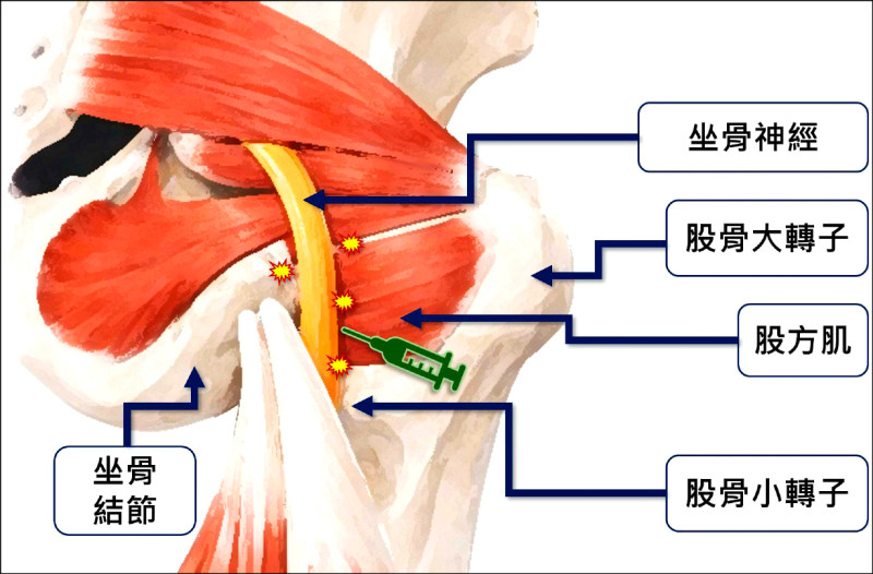 臀部疼痛無法久坐 可能是坐骨股骨夾擠症候群