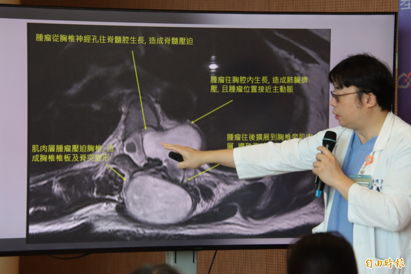 嘉基跨三科12小時高難度手術 助女子切除腫瘤重獲新生