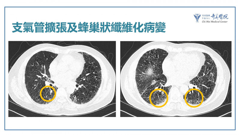 走路喘、咳不停別當老化！當心肺纖維化如「菜瓜布」