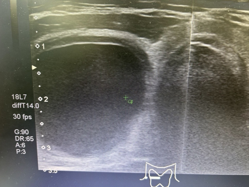 脖子長腫塊免驚！ 熟女甲狀腺囊腫「抽水」瞬間消退
