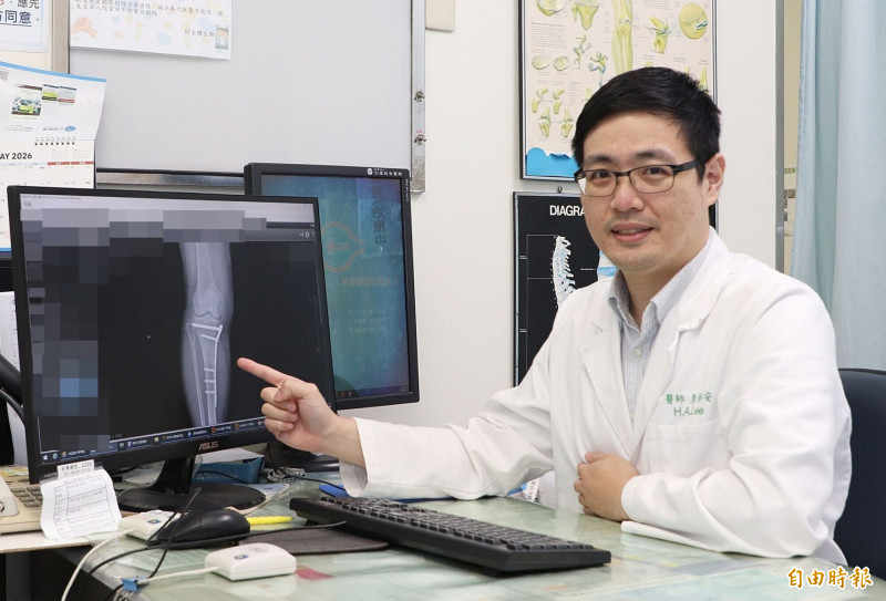 6旬婦膝蓋骨折腿部腫脹險截肢   固定手術＋高壓氧治療解危機