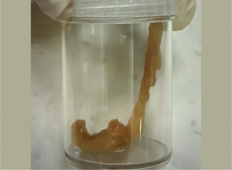 愛吃鮭魚生魚片小心！國小女童排便「拉出活蟲」 醫嚇喊：在蠕動