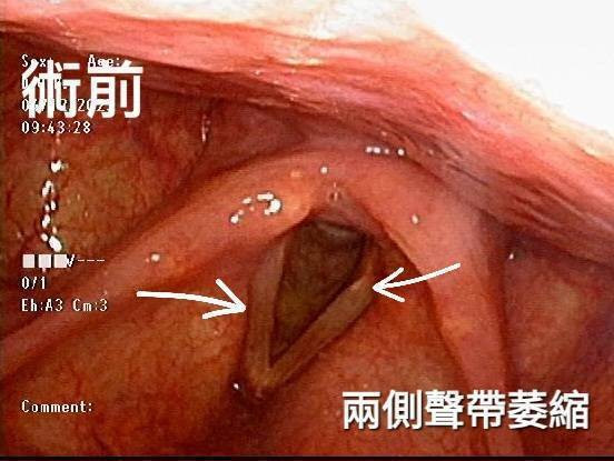 聲音沙啞有救！過度使用致聲帶萎縮 注射玻尿酸講話不再沙啞吃力