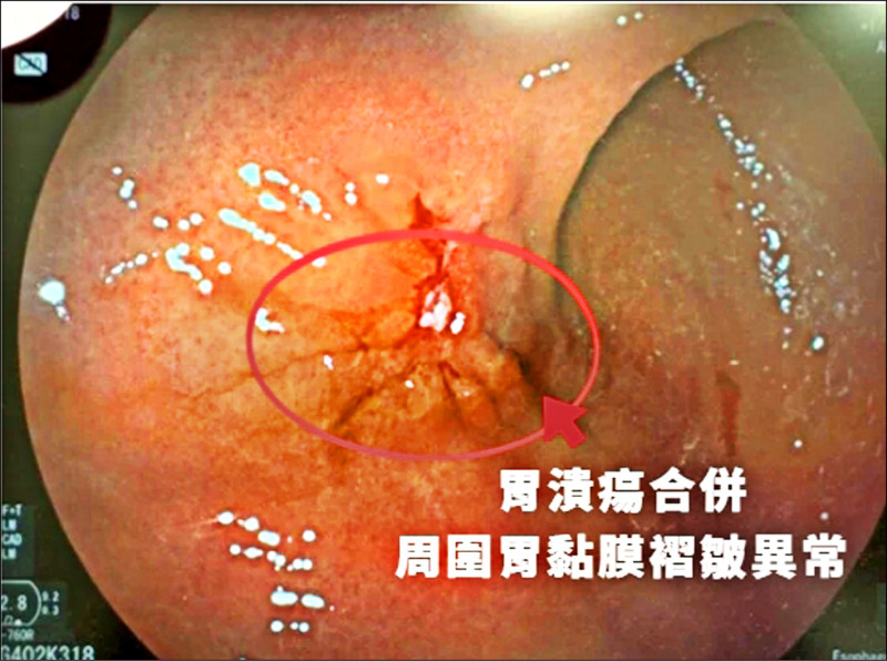 ▲黃俊文醫師表示,這名患者的病灶位於胃體中段,位置較少見;且潰瘍周圍胃壁皺褶出現異常拉扯、表面不平整,與常見良性潰瘍的型態不同。(中醫大新竹附醫提供) ▲黃俊文醫師表示,這名患者的病灶位於胃體中段,位置較少見;且潰瘍周圍胃壁皺褶出現異常拉扯、表面不平整,與常見良性潰瘍的型態不同。(中醫大新竹附醫提供)