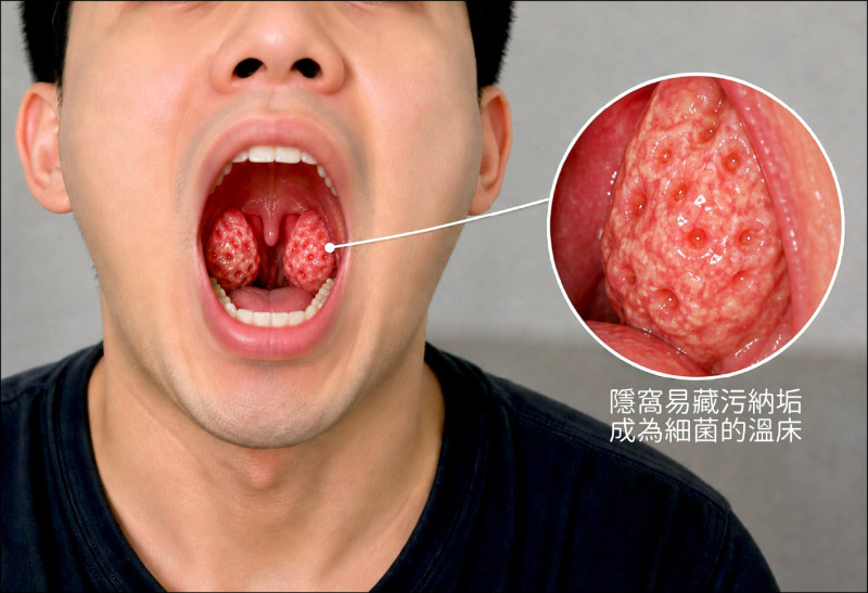 ▲扁桃腺隱窩容易成為細菌的溫床;圖為情境照,圖中人物與本文無關。(照片提供/温惟昇) ▲扁桃腺隱窩容易成為細菌的溫床;圖為情境照,圖中人物與本文無關。(照片提供/温惟昇)