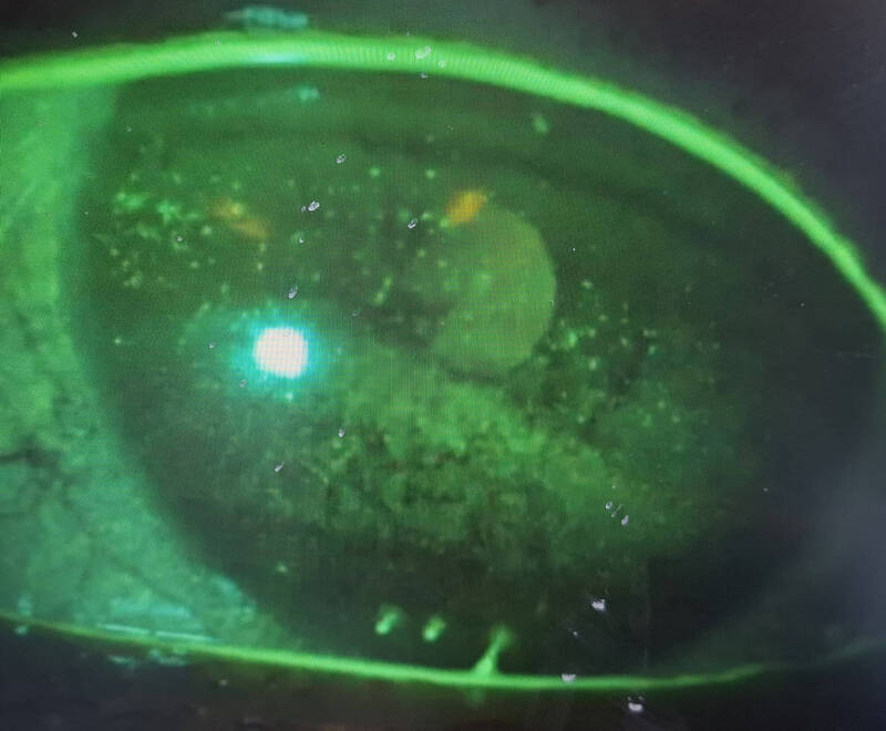 戴錯太陽眼鏡!女大生海邊曝曬4小時 角膜變「汽水泡泡」險瞎