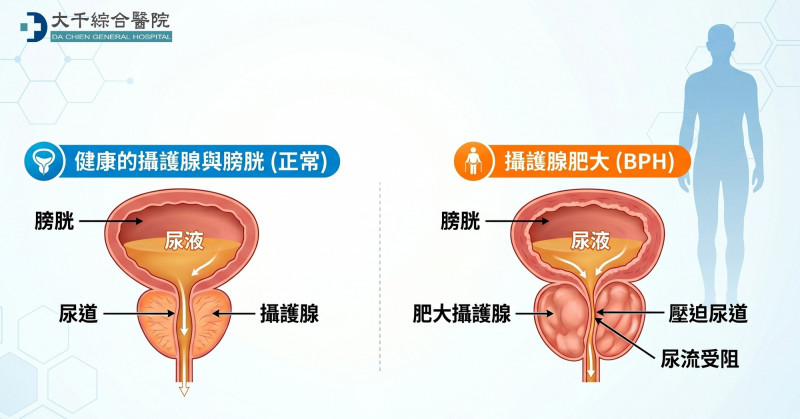 楊立宇醫師指出,攝護腺肥大若置之不理,可能引發尿道感染、腎臟損傷,甚至無法排尿。(大千綜合醫院提供) 楊立宇醫師指出,攝護腺肥大若置之不理,可能引發尿道感染、腎臟損傷,甚至無法排尿。(大千綜合醫院提供)