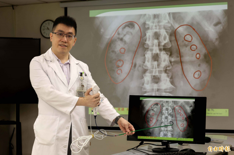 簡維弘醫師指出,患者雙側腎臟內都有明顯的「雷射斑」(小紅圈處),宛如兩顆鑲滿葡萄乾的雜糧麵包,利用軟式輸尿管鏡雷射碎石。(記者蔡淑媛攝) 簡維弘醫師指出,患者雙側腎臟內都有明顯的「雷射斑」(小紅圈處),宛如兩顆鑲滿葡萄乾的雜糧麵包,利用軟式輸尿管鏡雷射碎石。(記者蔡淑媛攝)