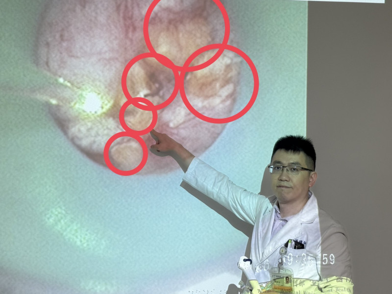 簡維宏醫師利用軟式輸尿管鏡到腎臟進行雷射打碎石(紅圈處)。(記者蔡淑媛翻攝) 簡維宏醫師利用軟式輸尿管鏡到腎臟進行雷射打碎石(紅圈處)。(記者蔡淑媛翻攝)