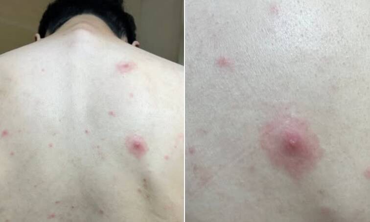 皮膚科醫師吳仁欽指出,水痘可能同時出現紅疹、膿皰與水泡,一眼便可認出。提醒不具免疫力者若接種水痘疫苗,也能降低感染風險。(圖擷取自吳仁欽臉書粉專) 皮膚科醫師吳仁欽指出,水痘可能同時出現紅疹、膿皰與水泡,一眼便可認出。提醒不具免疫力者若接種水痘疫苗,也能降低感染風險。(圖擷取自吳仁欽臉書粉專)
