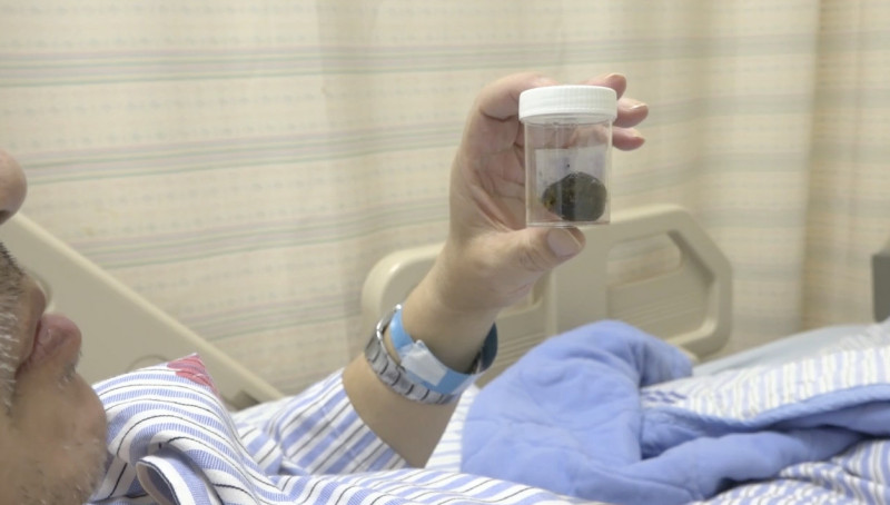 吳男將膽囊切除,並起出其中約3公分的結石。(彰化醫院提供) 吳男將膽囊切除,並起出其中約3公分的結石。(彰化醫院提供)
