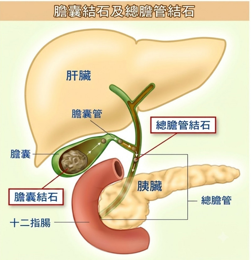 總膽管是輸送膽汁至十二指腸的必經通道, 膽汁一旦遭阻塞鬱積肝臟,便會造成肝細胞損傷(彰化醫院提供) 總膽管是輸送膽汁至十二指腸的必經通道, 膽汁一旦遭阻塞鬱積肝臟,便會造成肝細胞損傷(彰化醫院提供)