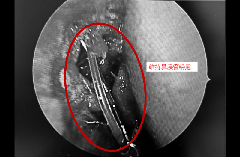 內視鏡鼻淚管手術精準打開阻塞的淚骨與黏膜,建立新的淚液引流通道,並置放矽質導管以維持通道暢通。(中醫大新竹附醫提供) 內視鏡鼻淚管手術精準打開阻塞的淚骨與黏膜,建立新的淚液引流通道,並置放矽質導管以維持通道暢通。(中醫大新竹附醫提供)