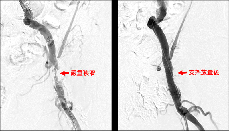 ▲血管攝影顯示患者周姓男子大腿動脈嚴重狹窄(左圖),經導管氣球擴張及支架置放後(右圖),成功恢復血流,提升下肢灌流,促進傷口癒合。(台南市立安南醫院提供) ▲血管攝影顯示患者周姓男子大腿動脈嚴重狹窄(左圖),經導管氣球擴張及支架置放後(右圖),成功恢復血流,提升下肢灌流,促進傷口癒合。(台南市立安南醫院提供)