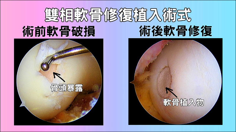 ▲透過「一次性雙相軟骨修復植入手術」,將軟骨細胞維持在原始的生長環境中,發揮最佳修復潛力。(中醫大新竹附醫提供) ▲透過「一次性雙相軟骨修復植入手術」,將軟骨細胞維持在原始的生長環境中,發揮最佳修復潛力。(中醫大新竹附醫提供)