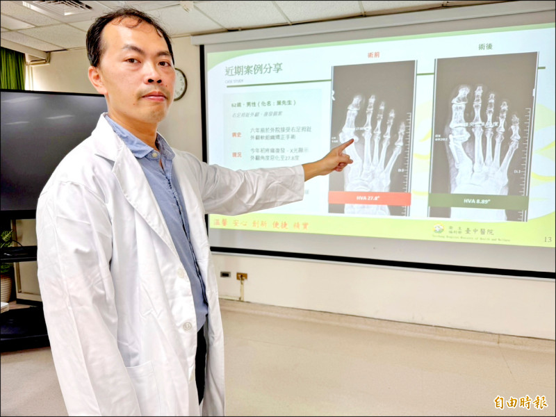 ▲周育名醫師說,患者到院時右腳拇趾外翻27.8度(左圖),疼痛難耐,經過截骨矯正手術後(右圖)恢復良好。(記者黃旭磊攝) ▲周育名醫師說,患者到院時右腳拇趾外翻27.8度(左圖),疼痛難耐,經過截骨矯正手術後(右圖)恢復良好。(記者黃旭磊攝)