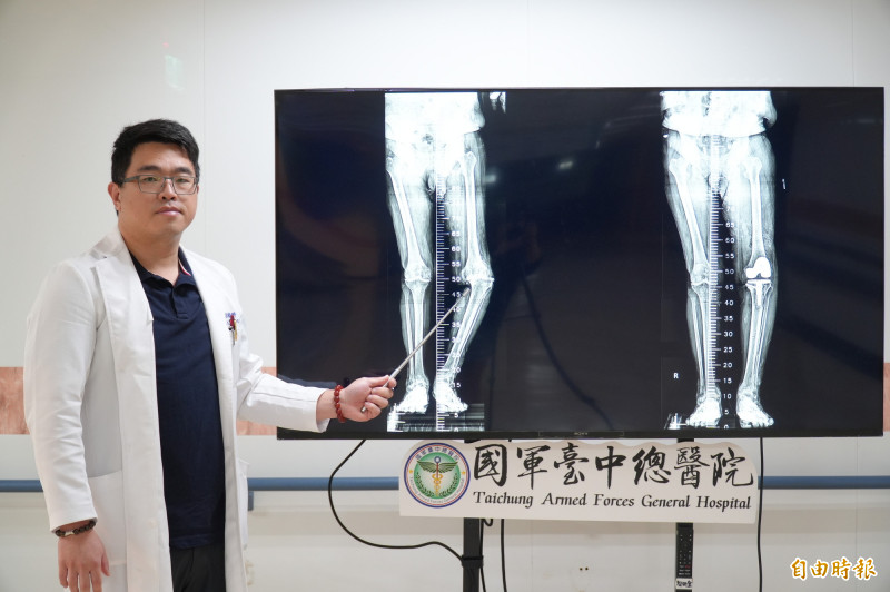 痛風30年膝蓋磨成「ㄑ字型」台中阿伯靠機械手臂開心走直線