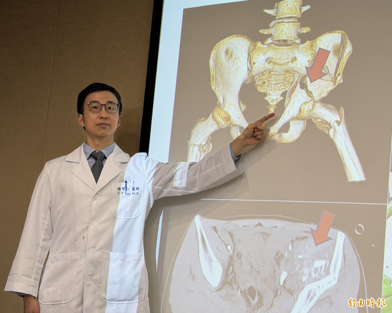 16歲少年5樓墜落骨盆大出血!三總「體內止血帶」搶命 目前復健中