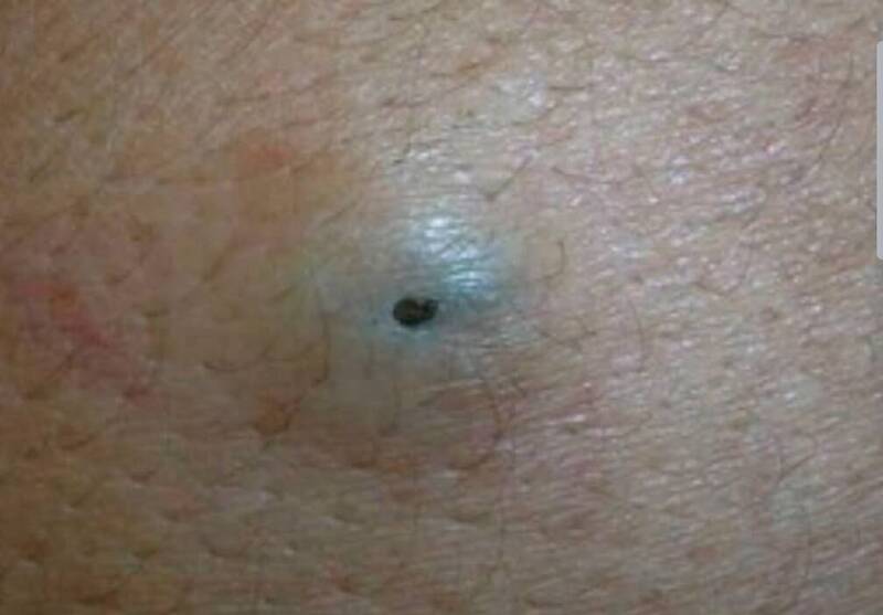 健康網》粉瘤擠出「臭乳酪」又滿血復活 醫揭沒除這東西是關鍵