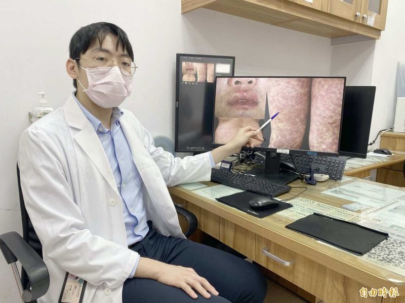 37歲女靠雞尾酒療法減重 突高燒、全身紅疹！竟是致命藥物過敏