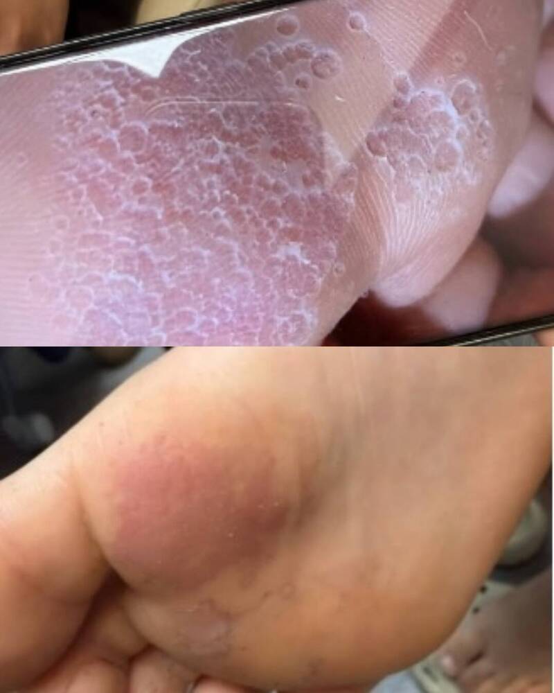 健康網》不是香港腳! 醫揭腳臭冒小洞恐是「毒襪子症候群」