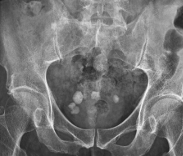 7旬翁攝護腺腫如大雞蛋、膀胱大結石 鈥雷射讓噓噓順了