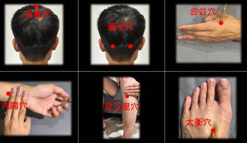 醫師提供穴位的位置。(中國附醫中醫部針灸科提供) 醫師提供穴位的位置。(中國附醫中醫部針灸科提供)