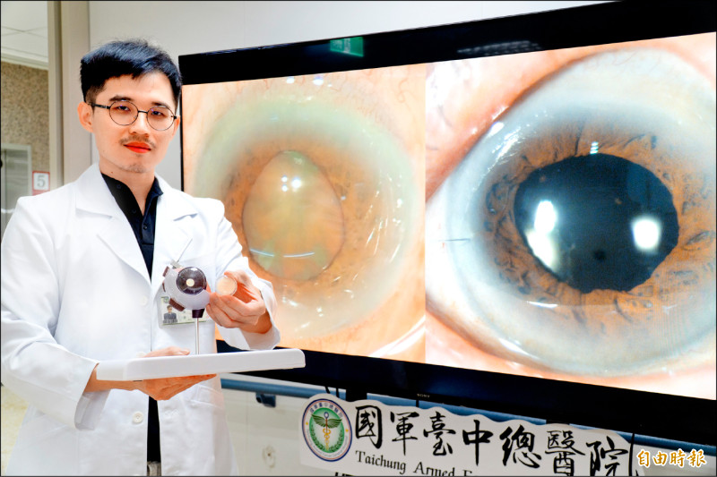 8旬翁嚴重白內障近失明 手術分段治療救回視力
