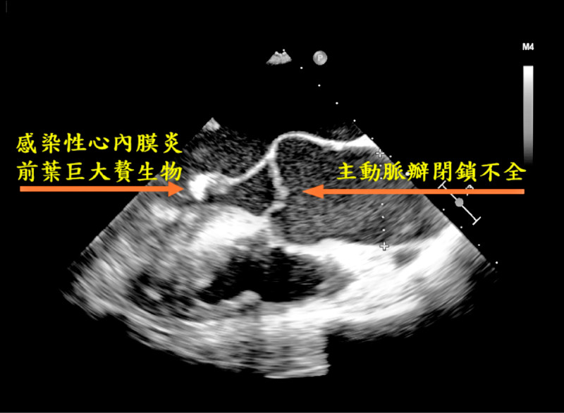 9旬翁瓣膜逆流引發心衰竭 全內視鏡手術搶命