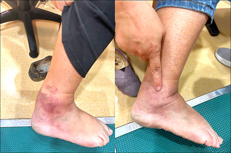 腳踝癢擦藥無效 元凶竟是下肢靜脈逆流