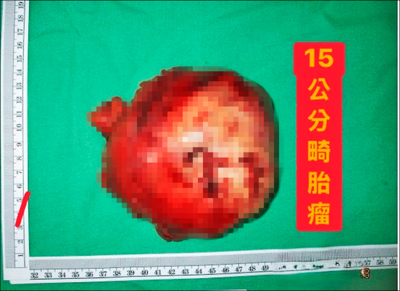 15公分胸腔巨瘤大如心臟 幸有驚無險