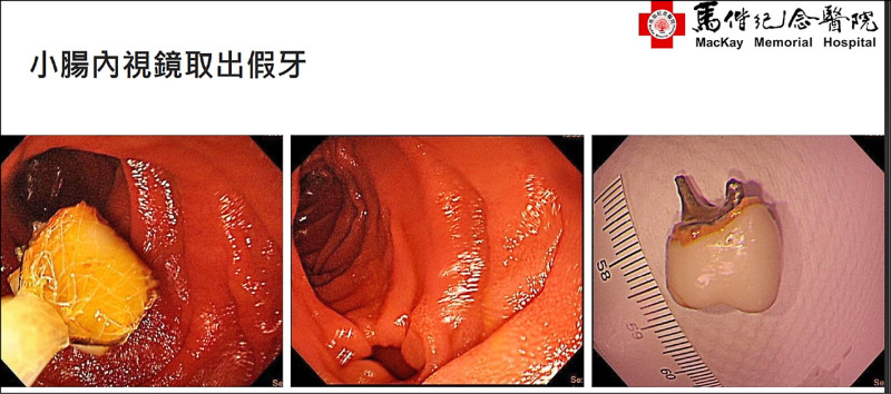 假牙卡腸2個月 單氣囊小腸鏡15分鐘取出