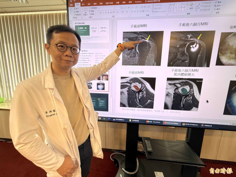 李坤燦醫師指張先生旋轉肌腱斷裂(箭頭指白色處)且肌腱薄,術後斷裂處已修補(箭頭指處),肌腱也生長增厚。(記者蔡淑媛攝) 李坤燦醫師指張先生旋轉肌腱斷裂(箭頭指白色處)且肌腱薄,術後斷裂處已修補(箭頭指處),肌腱也生長增厚。(記者蔡淑媛攝)