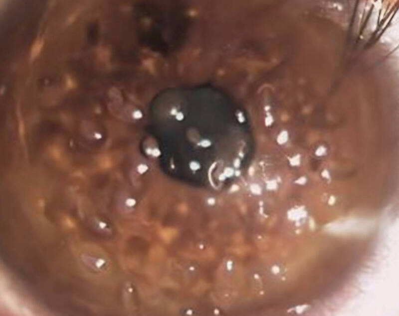 戴錯太陽眼鏡！女大生海邊曝曬4小時 角膜變「汽水泡泡」險瞎