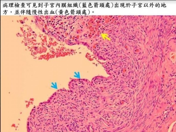 病理檢查可見到子宮內膜組織（藍色箭頭處）出現於子宮以外的地方，並伴隨慢性出血（黃色箭頭處）。（醫院提供）