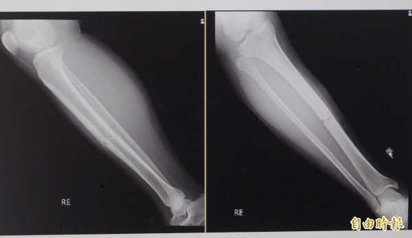 脛骨骨折症狀 陳舊性骨折 Doersd