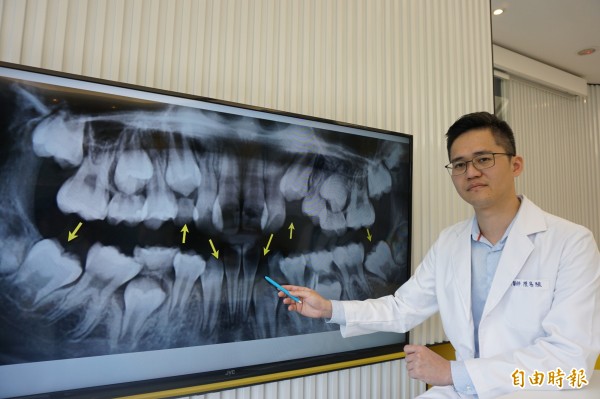 牙醫師陳易駿指出王姓國中生長期吃軟不吃硬，導致齒顎空間不足，牙齒長歪、爆牙還長不出來。（記者蔡淑攝）