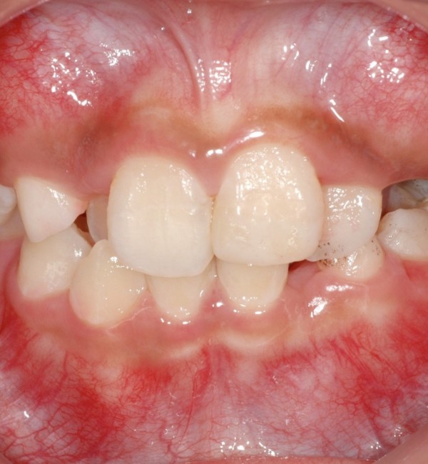 王姓國中生齒顎空間不足，門牙重疊、缺牙，犬齒卡在牙齦，無法完全萌發。（記者蔡淑媛翻攝）