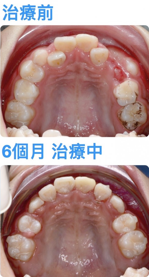 王姓國中生齒顎空間不足，牙齒亂長或長不出來，齒顎矯正半年後正常生長。（記者蔡淑媛翻攝）