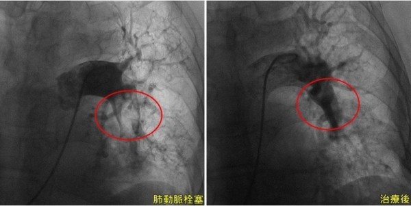台中一名練拳多年的王姓老伯，日前在家昏倒就醫檢查，發現肺動脈嚴重血栓（左），經「超音波震碎血栓導管」治療後，肺動脈恢復順暢（右）。（記者陳建志翻攝）