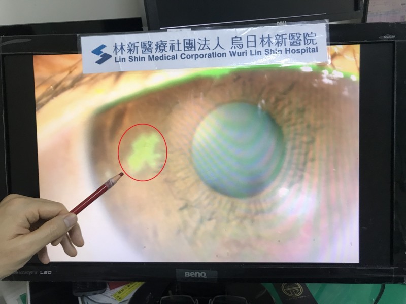 游姓女子在視力檢查時右眼度數只剩下0.5，角膜中央更出現像蛇行爬過的不規則破皮，一般無法用肉眼看出。
（記者蘇金鳳翻攝）