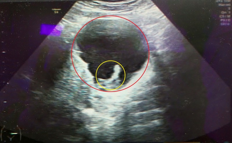 陳姓孕婦左邊卵巢有8公分的囊腫（紅圈處）且合併有硬塊（黃圈處）。（圖由大千綜合醫院提供）
