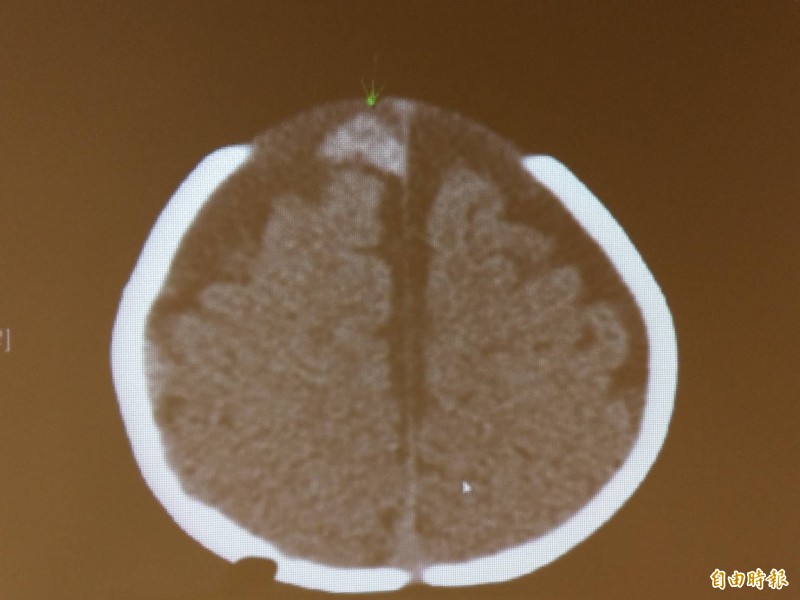 經電腦斷層檢查，小男嬰右腦處有出血。（綠箭頭處）（記者方志賢翻攝）