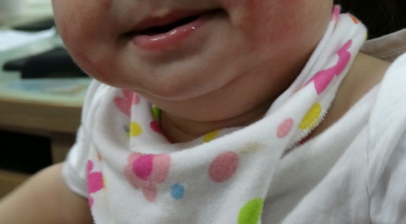 小男嬰雙頰濕疹。（記者湯世名翻攝）