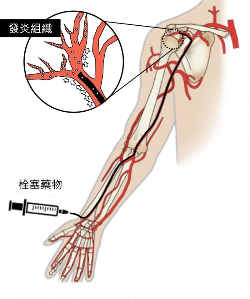 骨骼肌肉栓塞治療以導管從手部或鼠蹊部動脈注射藥物去除毛毛樣血管，改善發炎、疼痛。（記者蔡淑媛翻攝）