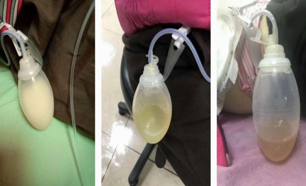治療期間,馮婦一度產生大量乳糜腹水(圖左);經 sirolimus 藥物治療3個月後,引流液混濁狀況逐漸改善(圖中);引流液於治療後3個半月呈現清澈黃色(圖右),故移除引流管。(記者湯世名翻攝) 治療期間,馮婦一度產生大量乳糜腹水(圖左);經 sirolimus 藥物治療3個月後,引流液混濁狀況逐漸改善(圖中);引流液於治療後3個半月呈現清澈黃色(圖右),故移除引流管。(記者湯世名翻攝)