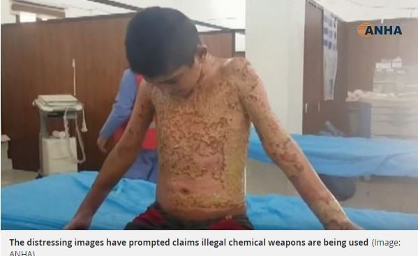 英國化學武器專家指出，男童看起來像遭「已被國際禁止」的「化學武器」白磷攻擊，才會造成如此嚴重的傷勢。（圖擷取自鏡報）