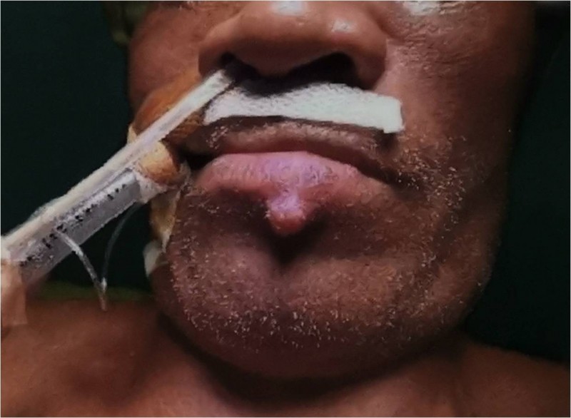 驚！60歲男子唇下長痘  就醫竟診出罹腎臟癌驟逝 - 生活 - 自由時報