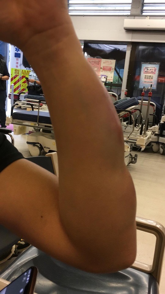 香港民陣召集人岑子杰今（29）日與友人遭到蒙面男子襲擊，友人遭打中3棍送醫治療。（圖擷取自民間人權陣線臉書）