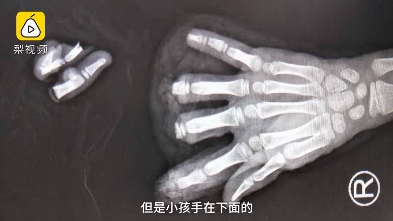 中國江蘇徐州一名8歲女孩，日前在家中的豆製品機器旁玩耍，結果叔叔沒注意到反而按下機器開關，導致小蕊右手慘被機器切斷4根手指。（圖擷取自梨視頻）